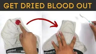 Get dried blood out of underwear and clothes and mattress with hydrogen peroxide