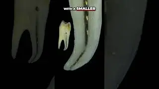 Dental Root Canal: Smooth Ledge, Irrigation, and File Technique #RootCanal #Dental #Endodontics