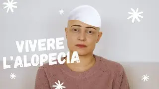 Vivere l'Alopecia Areata - La mia storia