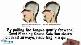 How do stop snoring mouthpieces work