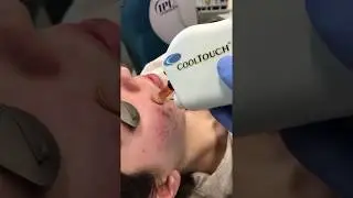 Dr David Rahimi Cooltouch CT3 laser forever young acne scars