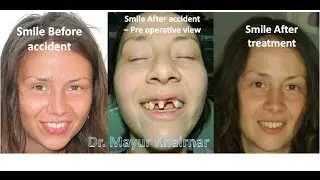 PreciGem Dental World - Regaining Smile with Dental Implants in 4 days