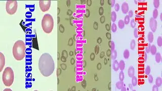 Hypochromia, Hyperchromia and polychromasia: Blood Smear Examination: blood smear Lecture  3