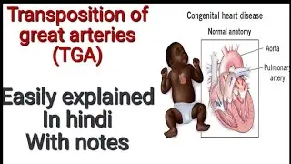 Transposition of great arteries(TGA)/Congenital heart disease/Medicine lecture in hindi #cvs #medico