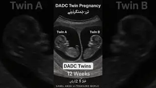 12 weeks twins pregnancy scan😱🥰_DADC twins pregnancy #ultrasound