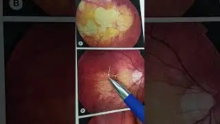 pathological myopia#myopiaawareness #myopia
