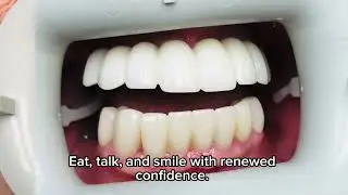 Fixed Implant Bridge vs Dentures &ndash; Permanent Upper Teeth Replacement | Prime Dentistry Philadelphia