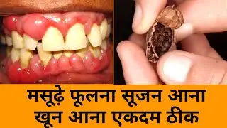मसूढ़ों की सूजन, मसूढ़े फूलना या खून आने की समस्या एकदम जड़ से ठीक हो जायेगी 100% पक्का इलाज
