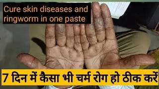 Medicinal benefits of chakramard / Cure skin diseases and ringworm in one paste / दाद ठीक करें