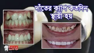 দাঁতের ক্যাপ কখন ভেঙ্গে যায় || Tooth cap || Dental Health Tips