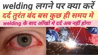 welding flash eyes weling pain /welding lagne par kya kare