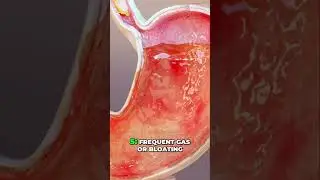 10 Early Colon Cancer Signs You Shouldn't Ignore