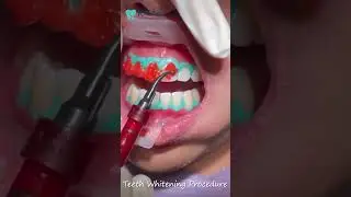 Discover Your Perfect Smile Advanced Whitening at | Kalash Orthodontics and Dental Care Raipur