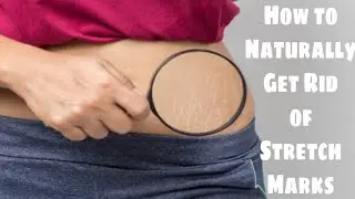 Stretch Marks Remove at Home || How to Get Rid of Pregnancy Stretch Marks || DIY Home Remedy
