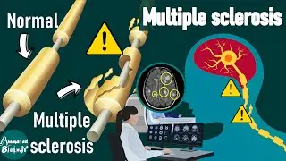 Multiple Sclerosis Explained: Causes, Symptoms, Diagnosis & Treatment| Neuropathology |USMLE lecture