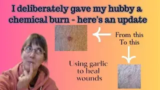 Healing with garlic? An update on a chemical burn I gave my husband to heal a wound on his leg
