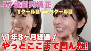 1年3ヶ月の成果報告｜前歯が引っ込んできたリアルな変化【40代矯正】