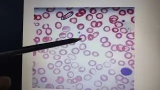 Iron deficiency anemia in peripheral blood smear