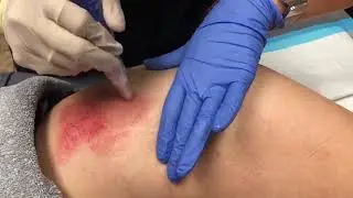 Microneedling for Outer Leg Stretch Marks