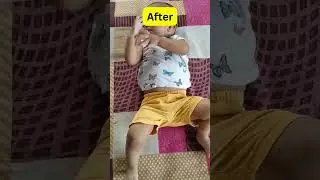 Amazing Transformation: Child Overcomes Clubfoot - Journey to Recovery | Dr. Sameer Desai