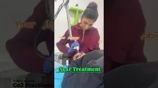 Scar removal treatment with fractional co2 laser #co2laser #scars #skintreatment #scartreatment