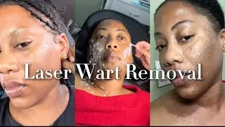 Laser Wart Removal | Honest Experience