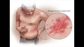 Infographic on shingles - Varicella-zoster