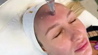Microneedling Treatment | Advanced Skin Rejuvenation at Contrasto Lux