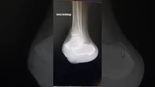 Ankle X-Ray AP & Lateral View | Post-Operative Case Explained | Radiology #shorts #viral #radiology