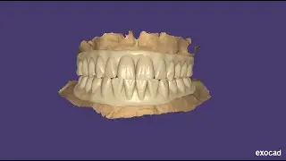 Upper & lower full mouth rehabilitation in exocad elefsina3.2