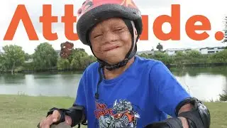 Burns Survivor: Dukie's Story