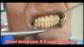 Full mouth rehabilitation