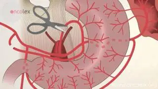 Esophagus resection &bull; Oncolex