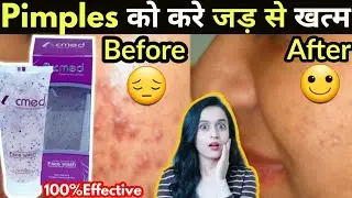 Facewash For oily Skin Acmed Facewash Review  @MissBairagi