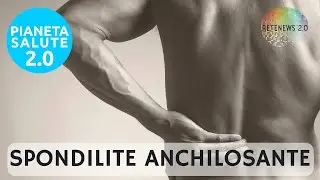 La Spondilite anchilosante: sintomi, cause, impatto, decorso e cura. PIANETA SALUTE 2.0