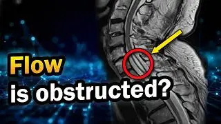Headaches When Coughing? Chiari Malformation & Syringomyelia MRI