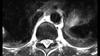 Epidural Hematoma with Spinal Cord Puncture Wound