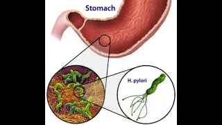 AGENTES MUT&Aacute;GENOS: QU&Iacute;MICOS,F&Iacute;SICOS Y BIOL&Oacute;GICOS - HELICOBACTER PYLORI-PAPILOMA VIRUS-CITOGEN&Eacute;TICA I