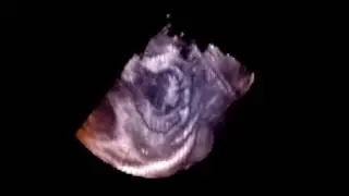 Advanced Real-Time Visualization for Robotic Heart Surgery