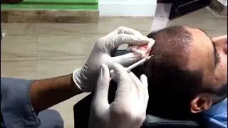 My PRP Session || PRP For Hair Regrowth Treatment || 12-10-2023 ||