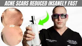 BYE-BYE Acne Scars: Reducing Acne Scars with LASERS | Dr. Jason Emer