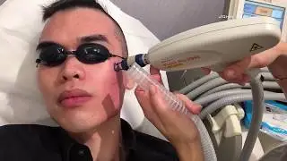 Pixel Laser Treatment | Before & After | Updates