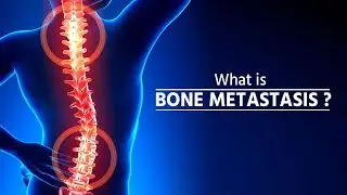 What is bone metastasis | Stage 4 Cancer | Bone Metastasis | How Cancer Spreads | metastasis |