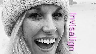 Buttons are gone! #invisalign #tray43 #theend #dientes #crookedteeth #vampireteeth