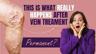 Is Vein Treatment Worth It? Hear The Shocking Patient Stories