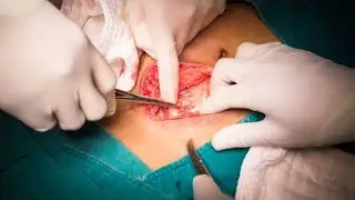 suffix -ectomy meaning in Hindi#medicalterminology