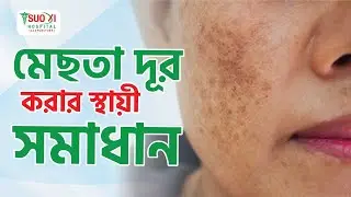 Say Goodbye to Melasma: Expert Advice & Solutions | Skin Care | SUO XI Hospital - Skin Care