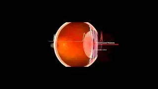 LENSTAR Training - Pachymetry