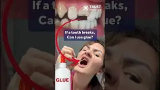 GLUE A BROKEN TOOTH? 🦷 #glue #brokentooth #mexicodentistry #tijuanadentistry #shorts #ytshorts