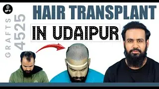 Hair Transplant in Udaipur | Cost of Hair Transplant in Udaipur | IFT Hair Science
